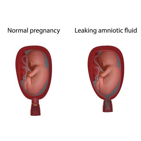 leaking fluid pregnancy|Leaking Amniotic Fluid 